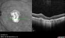 Outer-Retinal-Tubulation-jomi-082318_012.jpg