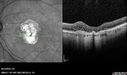 Outer-Retinal-Tubulation-jomi-082318_013.jpg