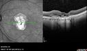 Outer-Retinal-Tubulation-jomi-082318_016.jpg