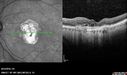 Outer-Retinal-Tubulation-jomi-082318_017.jpg