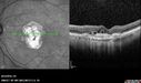 Outer-Retinal-Tubulation-jomi-082318_019.jpg