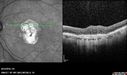 Outer-Retinal-Tubulation-jomi-082318_025.jpg