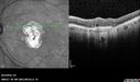 Outer-Retinal-Tubulation-jomi-082318_027.jpg