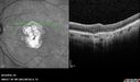 Outer-Retinal-Tubulation-jomi-082318_029.jpg