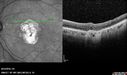 Outer-Retinal-Tubulation-jomi-082318_030.jpg