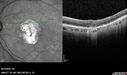 Outer-Retinal-Tubulation-jomi-082318_031.jpg