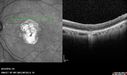Outer-Retinal-Tubulation-jomi-082318_032.jpg
