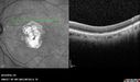 Outer-Retinal-Tubulation-jomi-082318_033.jpg