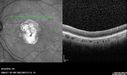 Outer-Retinal-Tubulation-jomi-082318_035.jpg