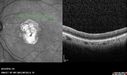 Outer-Retinal-Tubulation-jomi-082318_036.jpg