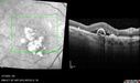 PED-cholesterol_elsup_022022_02.jpg
