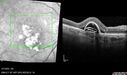 PED-cholesterol_elsup_022022_04.jpg