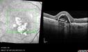 PED-cholesterol_elsup_022022_05.jpg