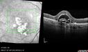 PED-cholesterol_elsup_022022_06.jpg