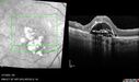 PED-cholesterol_elsup_022022_08.jpg