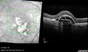 PED-cholesterol_elsup_022022_12.jpg