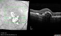 PED-cholesterol_elsup_022022_14.jpg