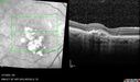 PED-cholesterol_elsup_022022_23.jpg