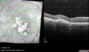PED-cholesterol_elsup_022022_24.jpg