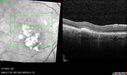 PED-cholesterol_elsup_022022_26.jpg