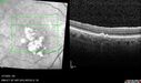 PED-cholesterol_elsup_022022_30.jpg