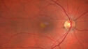 PatternDystrophy_96645_063022_01.jpg