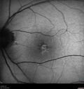 PatternDystrophy_96645_063022_04.jpg