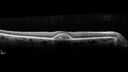 PatternDystrophy_96645_063022_08.jpg