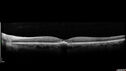 PatternDystrophy_96645_063022_10.jpg