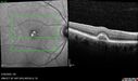 PatternDystrophy_96645_063022_12.jpg