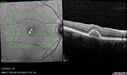 PatternDystrophy_96645_063022_13.jpg