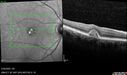 PatternDystrophy_96645_063022_19.jpg