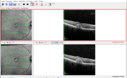 PatternDystrophy_96645_fu_20.PNG