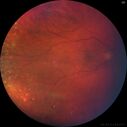 PigmentDegeneration_pamcc_081621_03.jpg