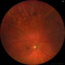 PigmentDegeneration_pamcc_081621_04.jpg