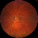 PigmentDegeneration_pamcc_081621_07.jpg