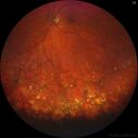 PigmentDegeneration_pamcc_081621_08.jpg