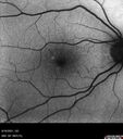 PigmentDegeneration_pamcc_081621_10.jpg
