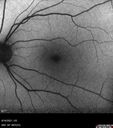 PigmentDegeneration_pamcc_081621_11.jpg