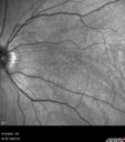 PigmentDegeneration_pamcc_081621_13.jpg