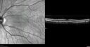 PigmentDegeneration_pamcc_081621_16.jpg