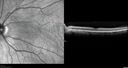 PigmentDegeneration_pamcc_081621_17.jpg