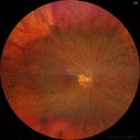 RP-RHOmutation_suric_073020_01.jpg