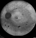RP-RHOmutation_suric_073020_04.jpg