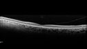 RP-RHOmutation_suric_073020_08.jpg