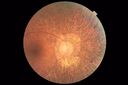 RetinitisPigmentosa_sclee_062518_02.JPG