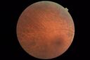 RetinitisPigmentosa_sclee_062518_03.JPG