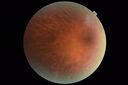 RetinitisPigmentosa_sclee_062518_04.JPG
