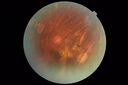 RetinitisPigmentosa_sclee_062518_05.JPG