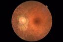 RetinitisPigmentosa_sclee_062518_07.JPG